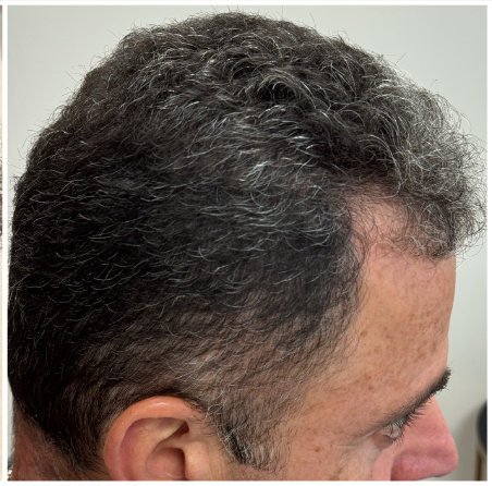 Exosome Hair Therapy after — Crown Thinning, Male Pattern Hair Loss, Reduced Scalp Coverage, front view
