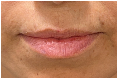 Lip Filler before — Thin Lips, Perioral Aging, Lip Lines, Fine Lines, Wrinkles, front view