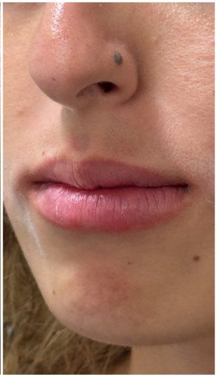 Lip Filler after — Lip Volume, Lip Projection, Lip Profile, front view