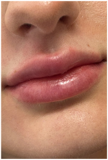 Lip Filler after — Volume Loss, front view