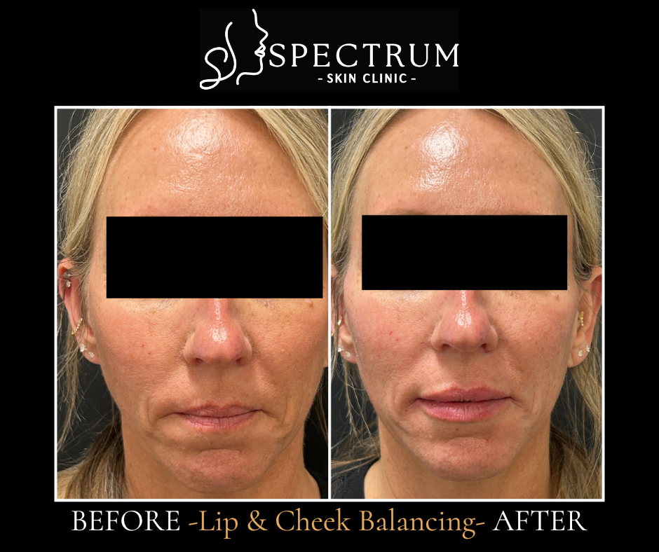 Lip and Cheek Filler Before & After | Facial Balancing