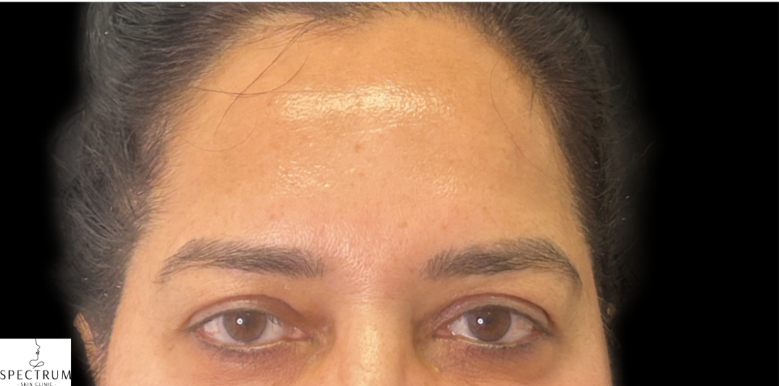 dysport before — fine-lines-wrinkles, front view