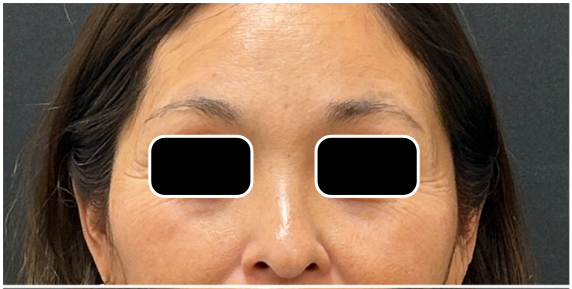 eMatrix before — fine-lines-wrinkles, sagging-laxity, enlarged-pores, front view