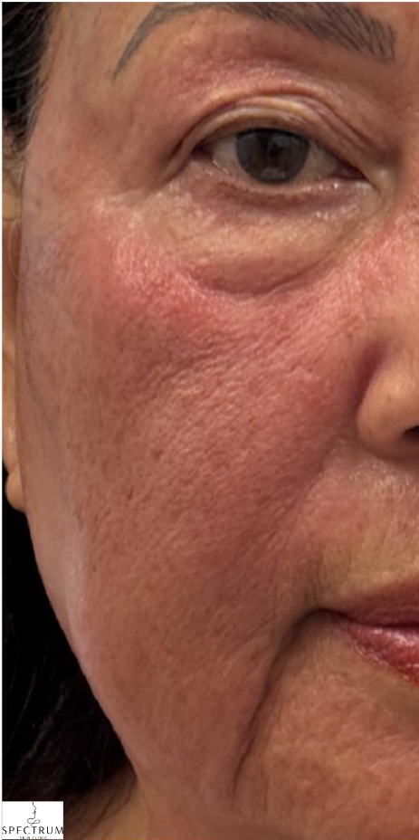 Secret PRO after — Uneven Texture, Fine Lines and Wrinkles, Skin Tone, front view