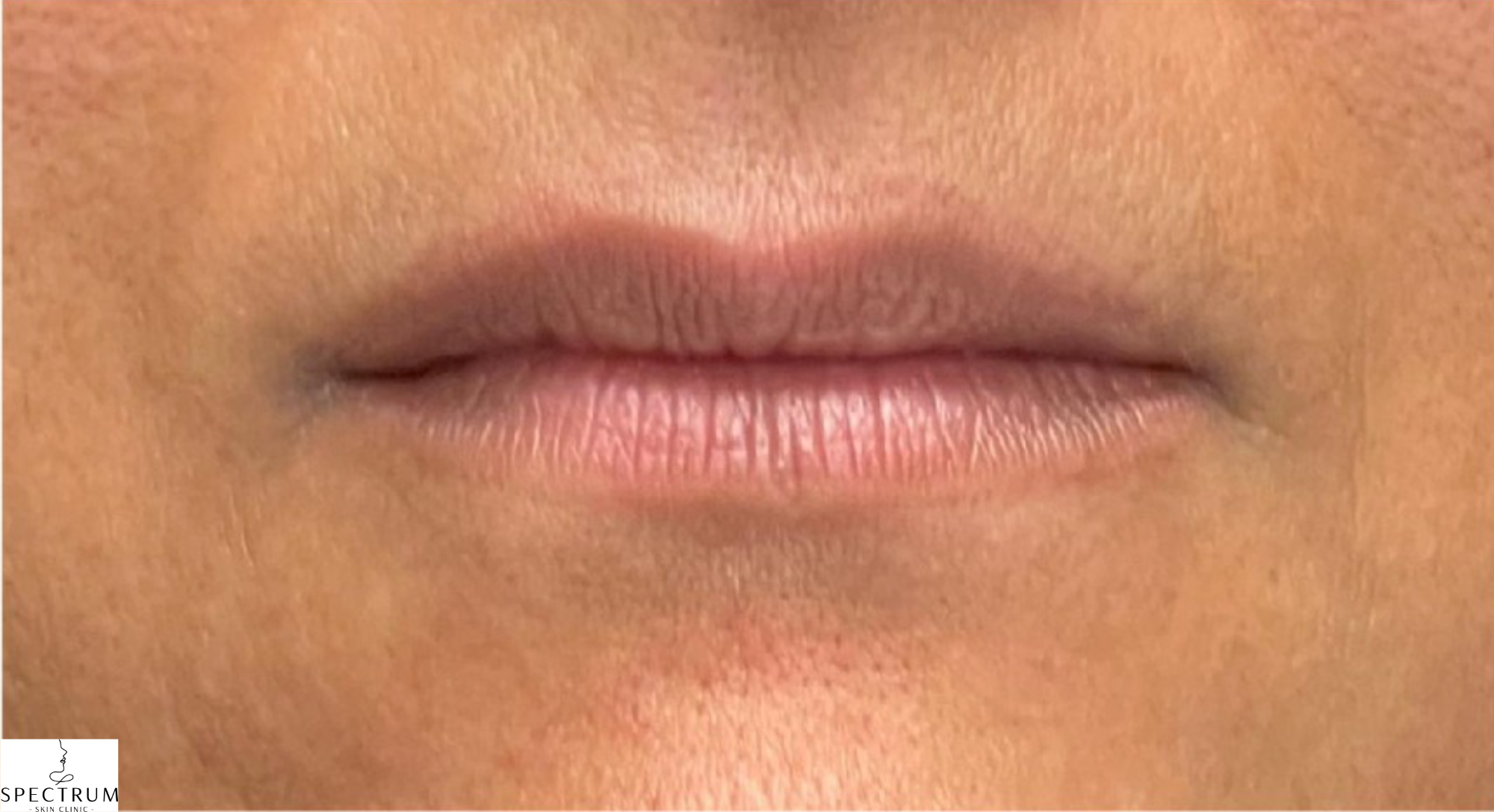 Lip Filler before — Thin Lips, front view