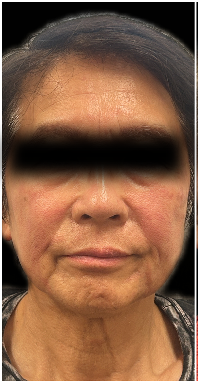 CO2 Laser Resurfacing Before & After | Skin Renewal in a Male Patient — before