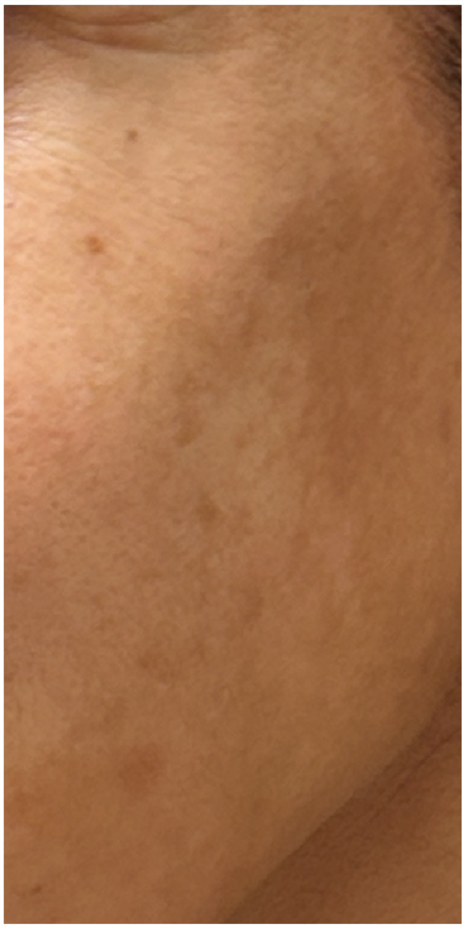 IPL Photofacial, Nordlys IPL after — Sun Damage, Hyperpigmentation, Facial Redness, Visible Vessels, Uneven Skin Tone, front view
