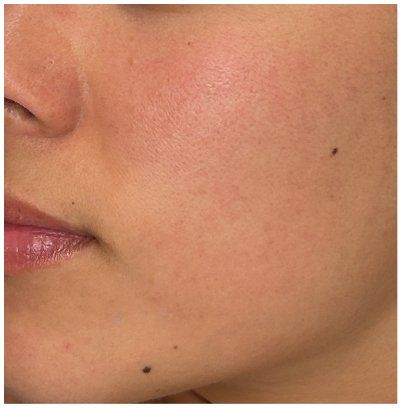 Micropeel, Chemical Peel before — Sensitive Skin, Redness, Uneven Skin Tone, Dull Skin, front view