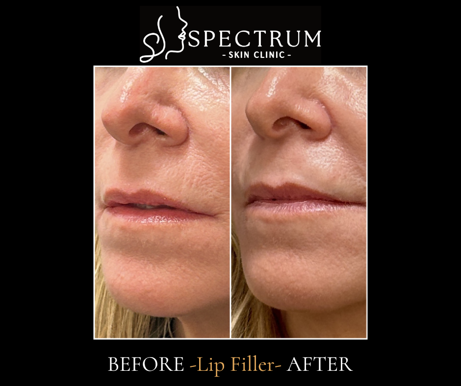 Lip Filler Before & After | Restoring Definition and Balance (Oblique View)