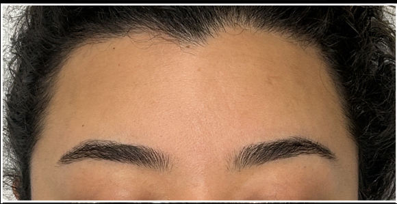 Botox Brow Lift before — Low Brows, Heavy Brows, Tired Eye Appearance, front view