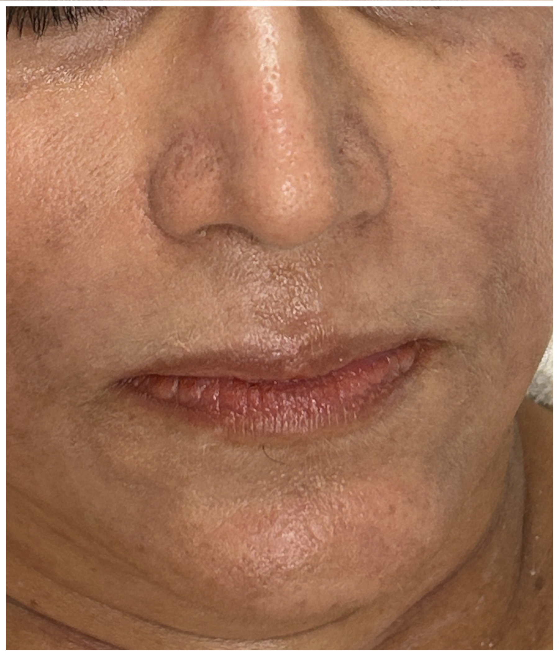 Chemical Peel for Pigment Correction before — Melasma, Hyperpigmentation, Sun Damage, front view