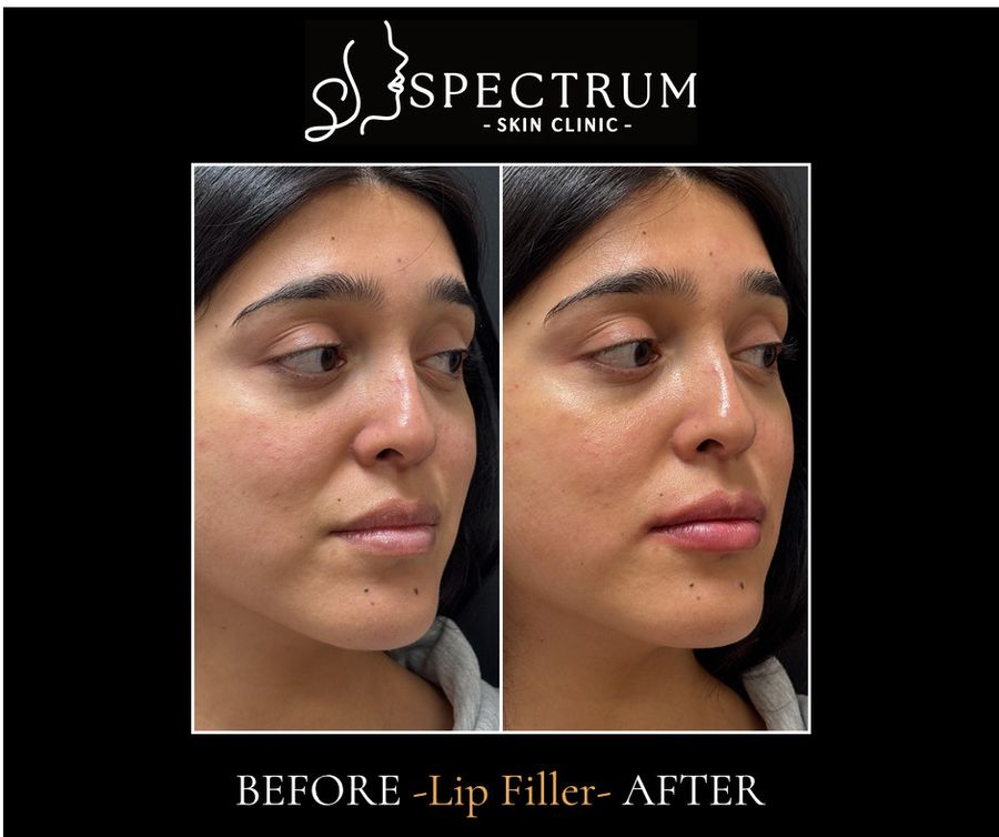 Lip Filler Before & After | Natural Volume and Definition (Oblique View)