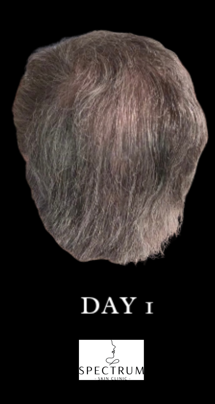 PRFM Hair Therapy before — Thinning Crown, Hair Density Loss, front view
