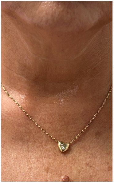 Q-Switch Nd:YAG Laser before — Sun Damage, Brown Discoloration, Uneven Skin Tone, Neck and Chest, front view
