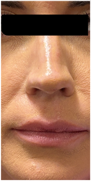Lip Filler after — Thin Lips, front view