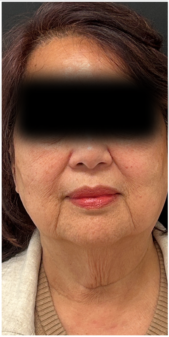 Laser Resurfacing Before & After | Lower Face and Neck Rejuvenation — before