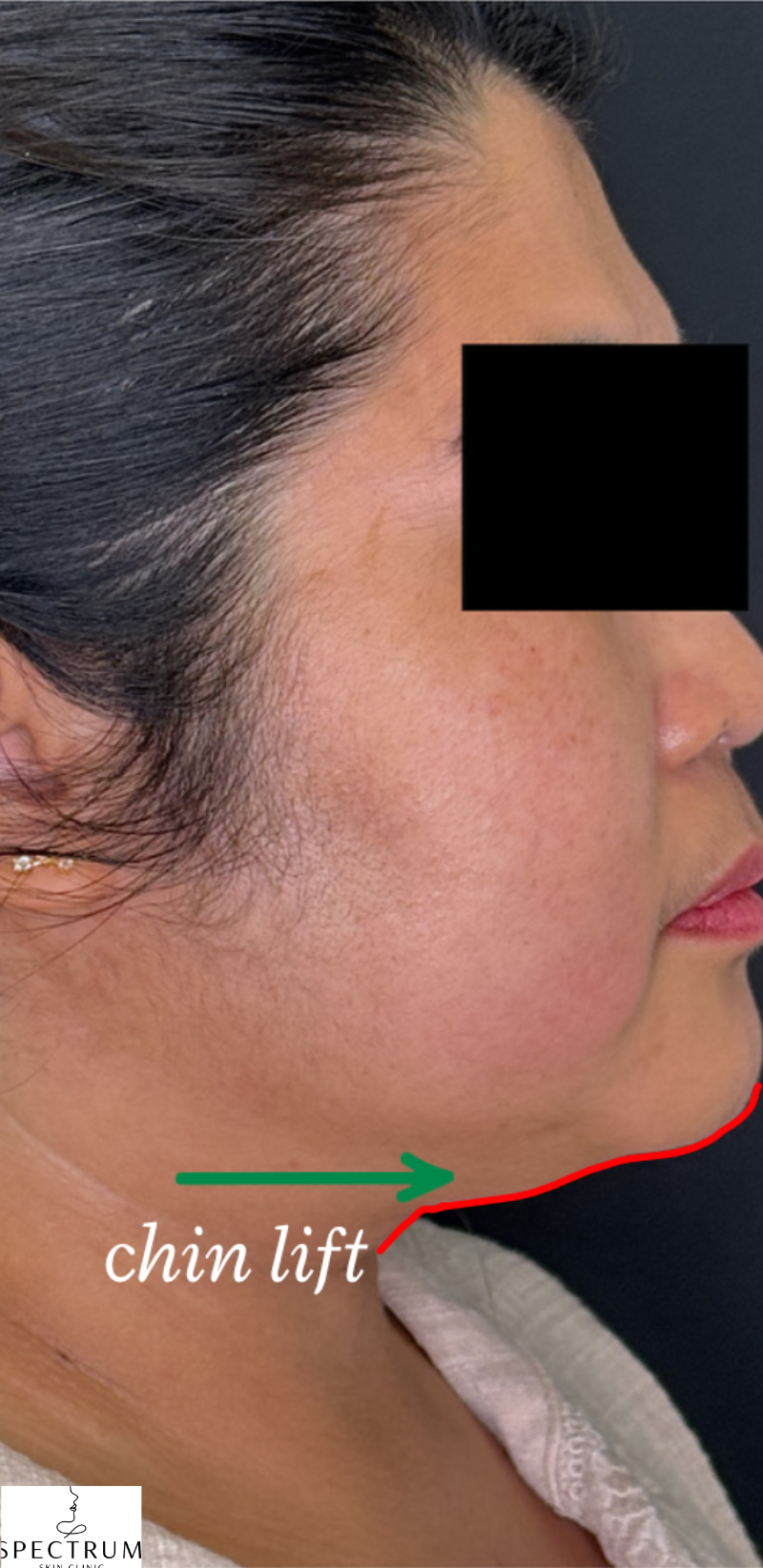 HIFU after — Double Chin, Submental Fullness, Sagging and Laxity, front view