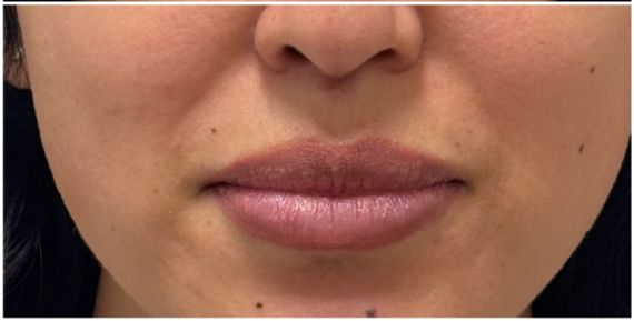 Lip Filler after — thin lips, lip volume, lip definition, vermilion border, front view