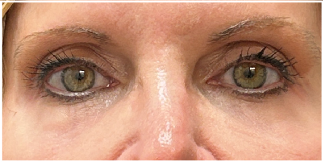CO2 Laser Resurfacing for Eyes Before & After | Fine Line and Texture Renewal — before