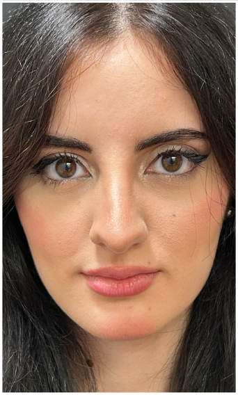 Masseter Botox after — Bruxism / TMJ, Wide Jawline, front view