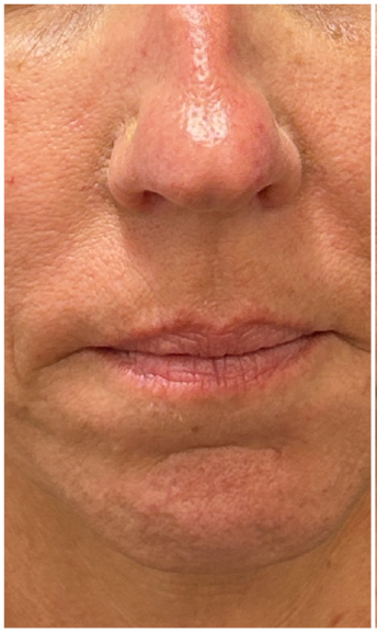 Lip Filler before — Thin Lips, Lip Volume Loss, Undefined Lip Border, Lip Asymmetry, front view