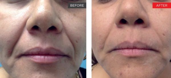 Fotona 4D Before and After | Skin Firming and Glow