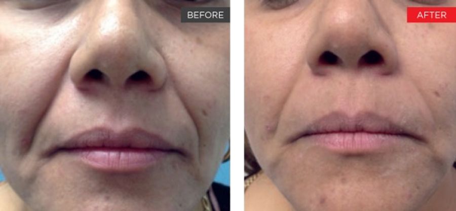 Fotona 4D Before and After | Skin Firming and Glow