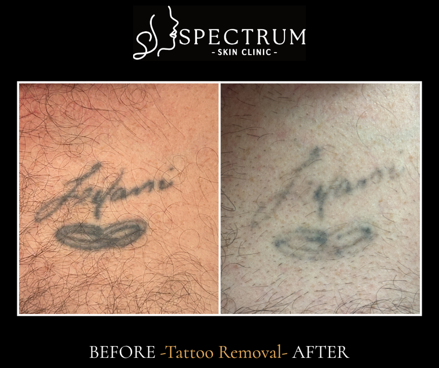 Tattoo Removal Before & After | Progressive Pico Laser Fading in a Male Patient