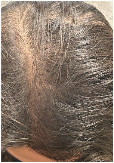 Exosome Therapy after — Crown Thinning, Vertex Thinning, front view