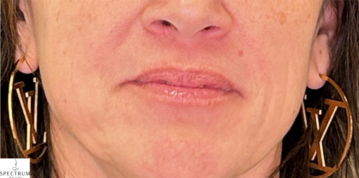 Lip Filler before — Volume and Definition, front view