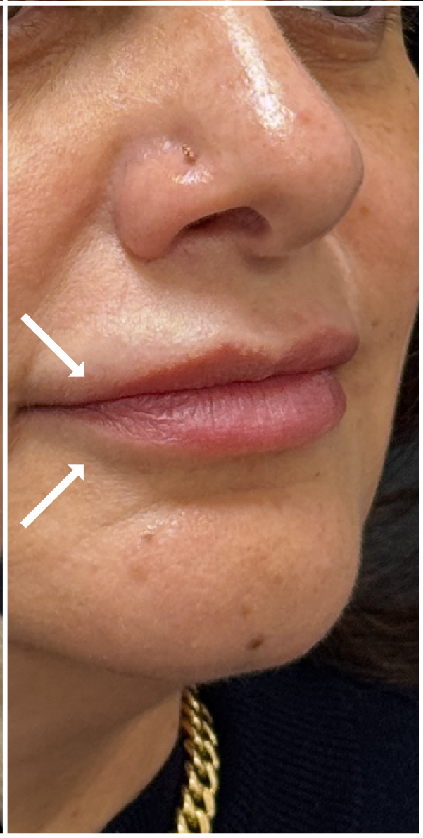 Lip Filler Dissolve after — Old migrated lip filler, loss of natural lip border, asymmetry, heaviness above the upper lip, undefined lip shape, unnatural appearance from previous filler, front view