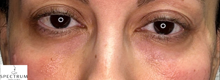 PRFM Under Eye after — Under Eye Hollows, Dark Circles, Uneven Texture, front view