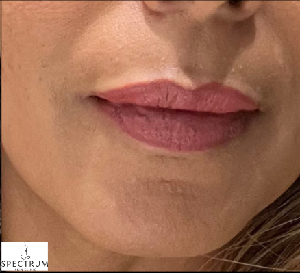 Lip Flip after — Flat upper lip and minimal lip show, front view