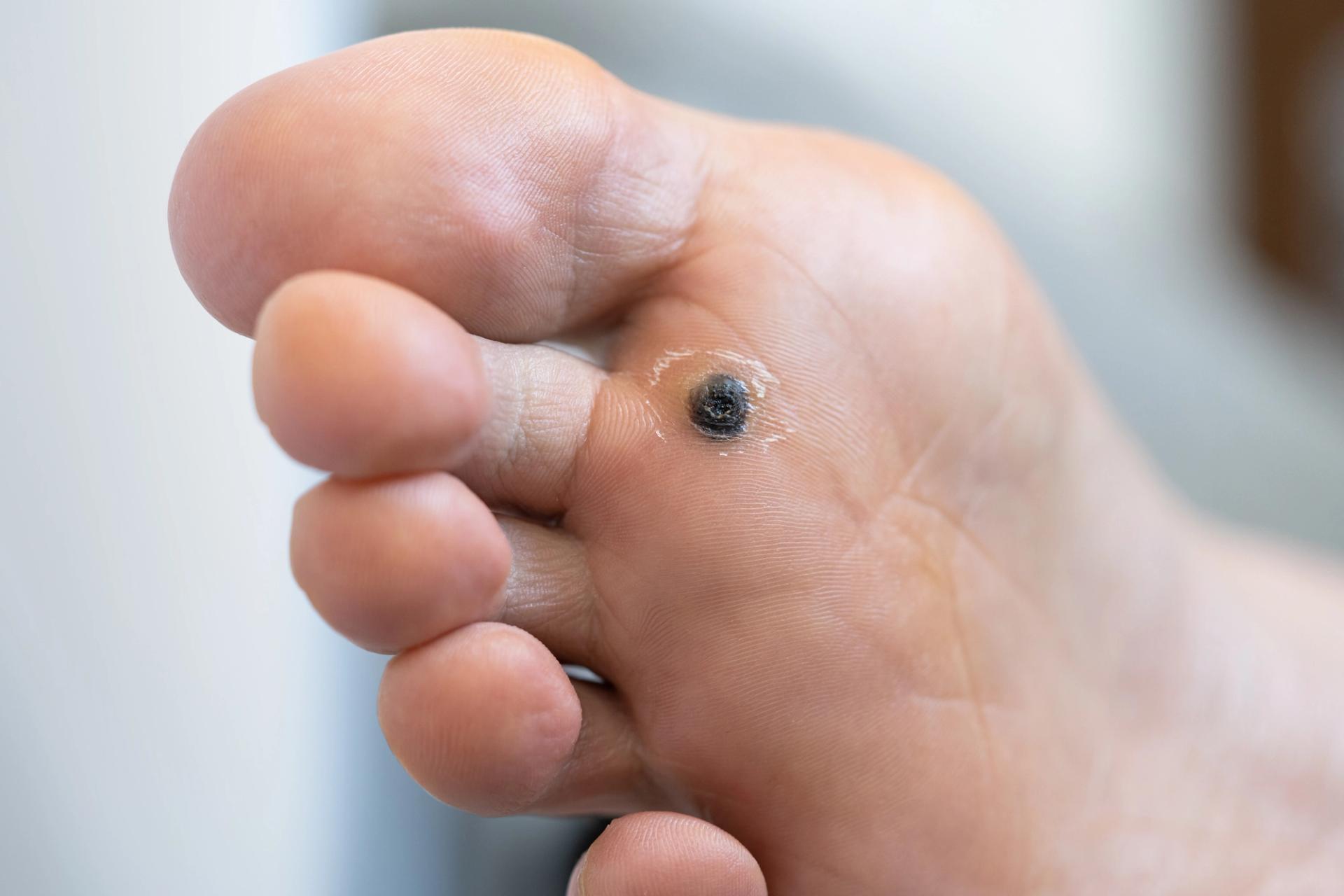 Wart & Skin Tag Removal in Irvine, CA performed by Dr. Sabeen Munib, MD