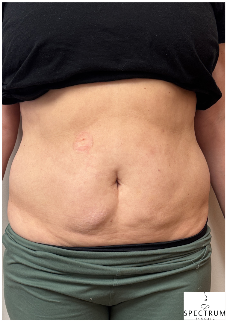 Body Cavitation before — Localized Fat, Body Contouring, Abdominal Fat, front view