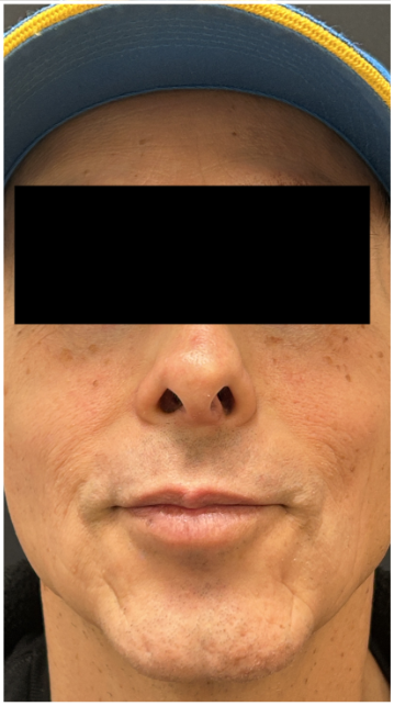 Lip Filler before — Thin Lips, front view