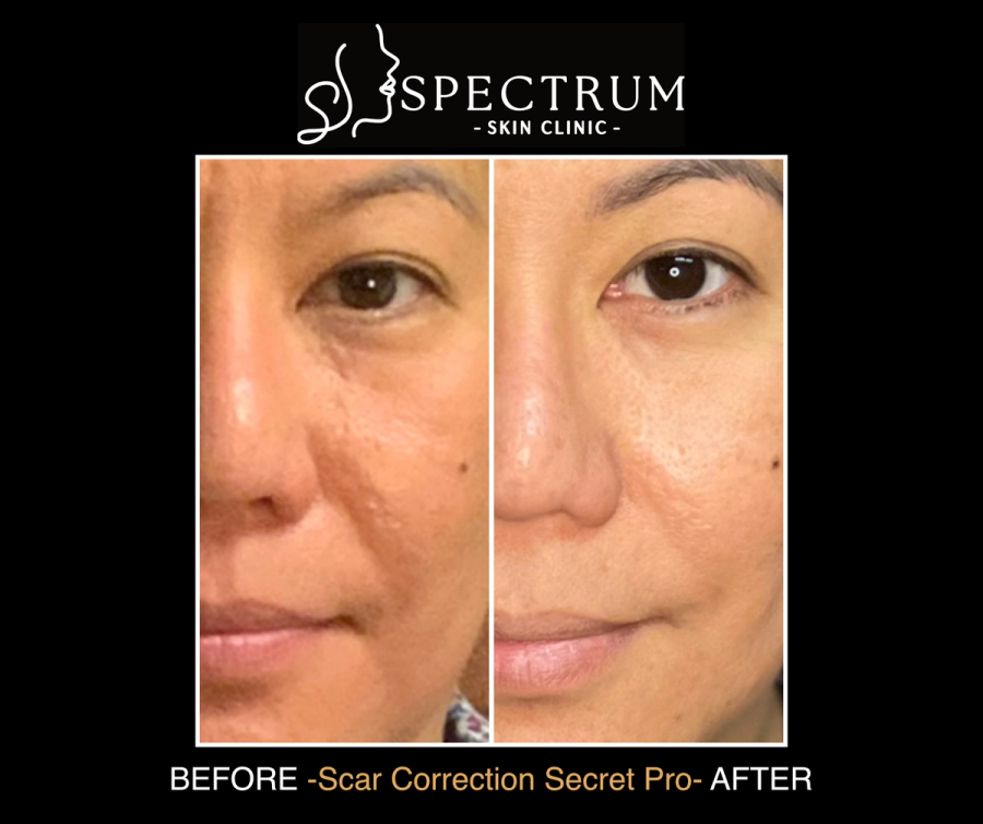 Secret PRO Before & After | Acne Scar Correction with Combined Resurfacing