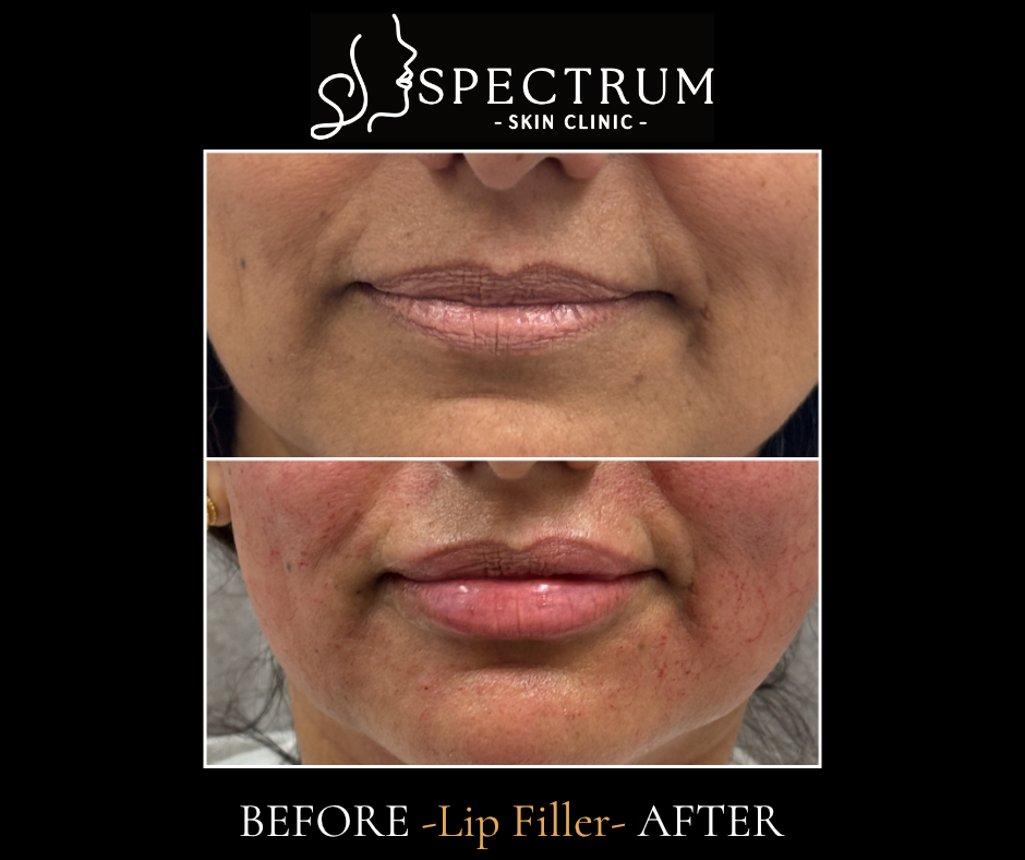 Lip Filler – Hydration & Texture Restoration for Mature Lips