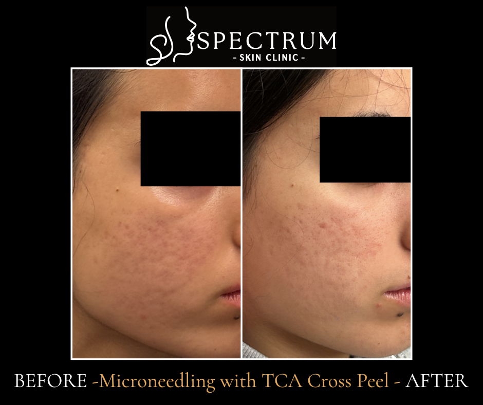 Microneedling and TCA CROSS Before and After | Acne Scar Refinement