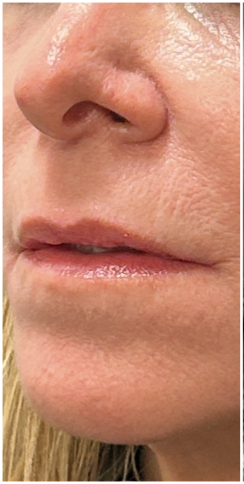 Lip Filler before — Thin Lips, Volume Loss, Lip Definition, Loss of Lip Border, front view