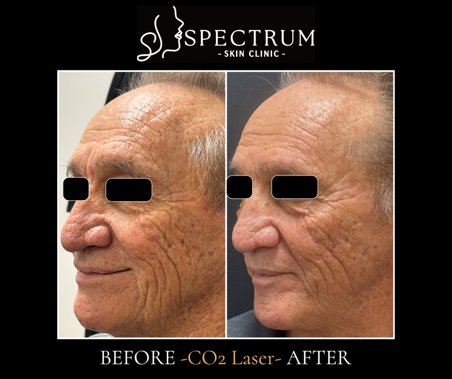 CO2 Laser Before & After | Eye and Perinasal Wrinkle Resurfacing