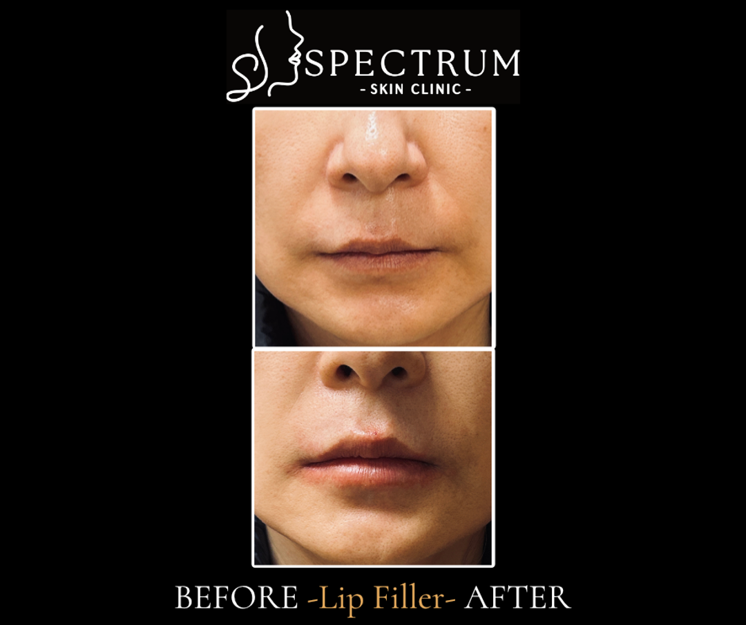 Thin vermilion with an intact lip border. This is the presentation that responds most predictably to a conservative first dose.
