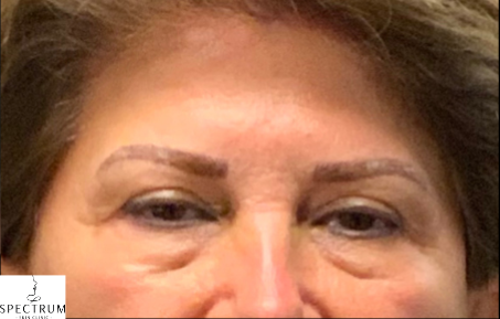 jeuveau before — Frown lines, forehead lines, brow tension, front view