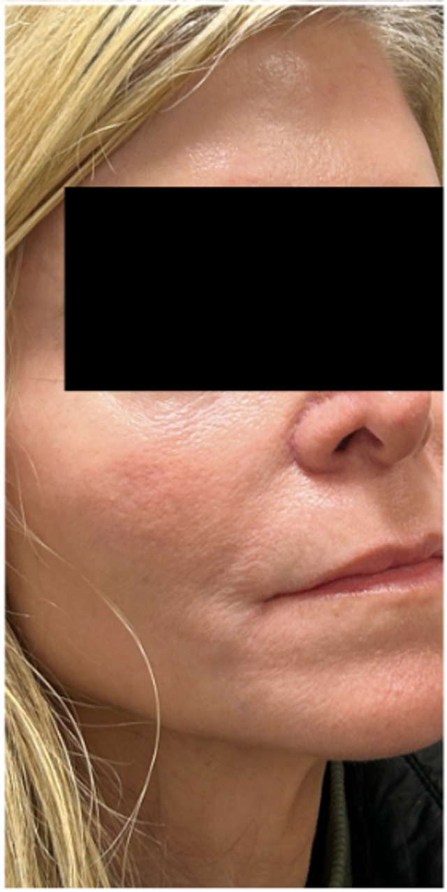 CO2 Laser Before & After | Perioral Lines and Skin Texture (Oblique View) — before