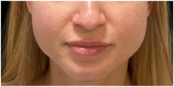 Masseter Botox before — Wide Jawline, front view
