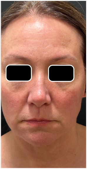 Light & Bright IPL after — Sun Damage, Hyperpigmentation, Facial Redness, Uneven Skin Tone, front view