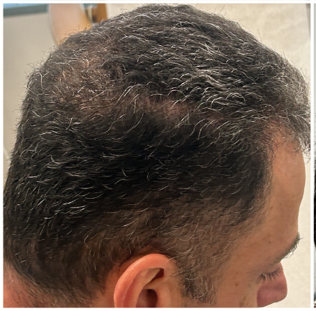 Exosome Hair Therapy before — Crown Thinning, Male Pattern Hair Loss, Reduced Scalp Coverage, front view