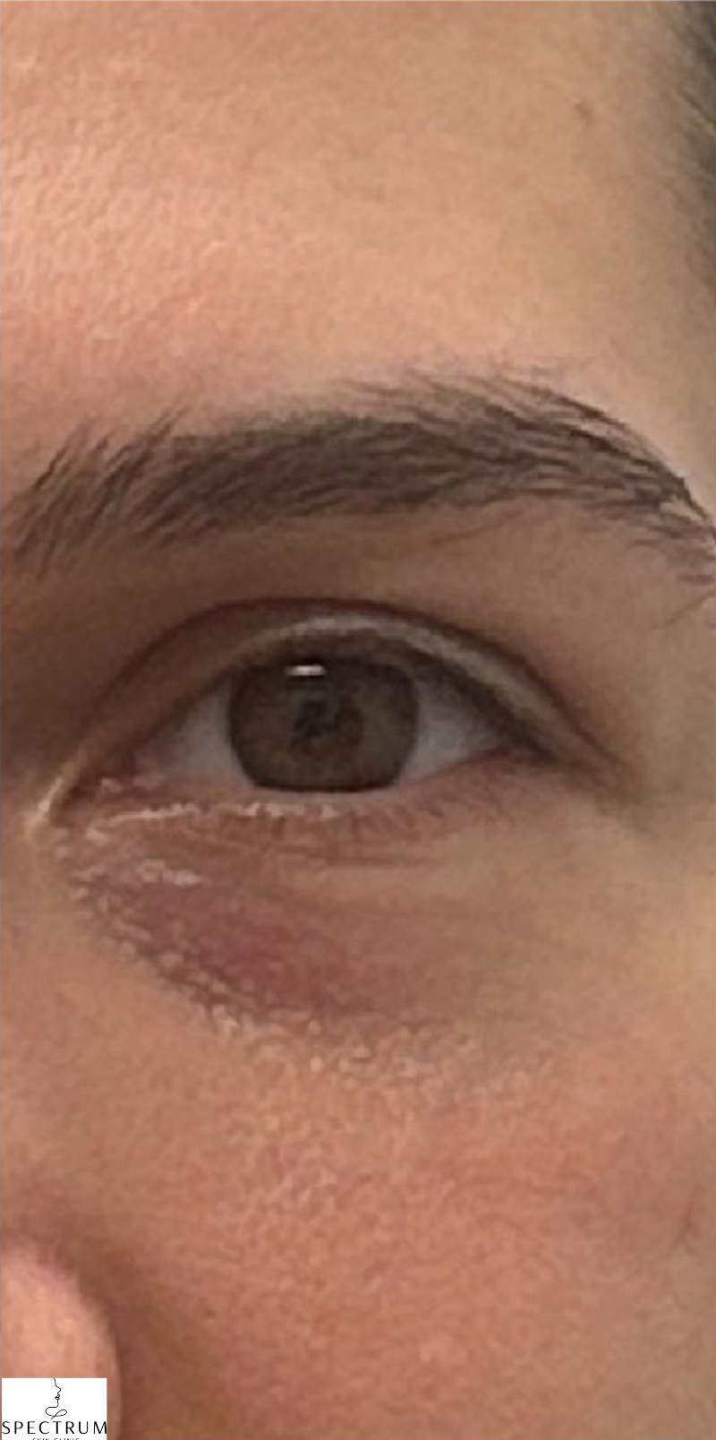 Rejuran PDRN before — Dark Circles, Fine Lines and Wrinkles, Crepey Eyelid Skin, Skin Quality, front view