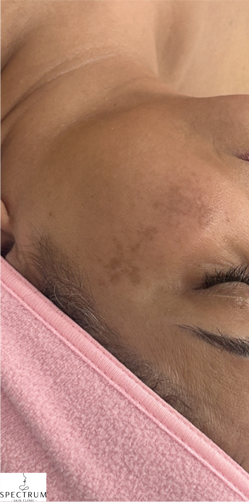 Chemical Peel for Acne Scarring before — Acne Scars, Post-Inflammatory Hyperpigmentation, Uneven Texture, front view