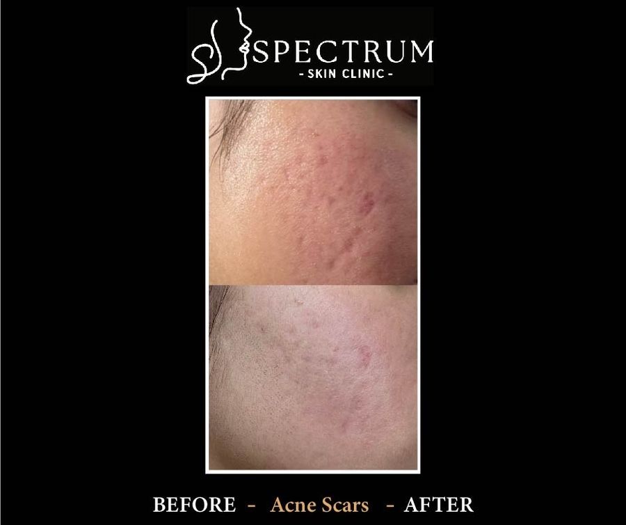 Acne Scars Before & After | Treatment with RF Microneedling and TCA Cross Peel